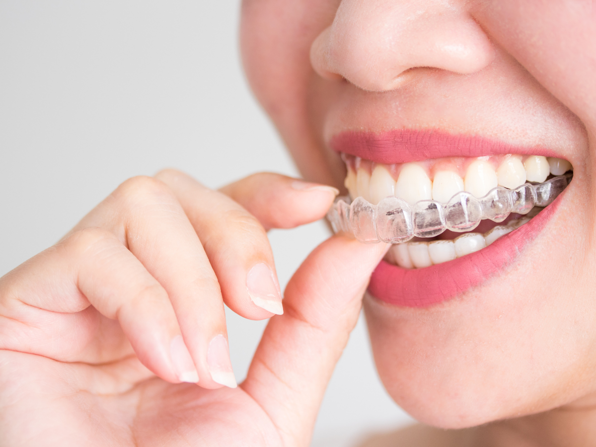 Woman inserts clear aligner into mouth.