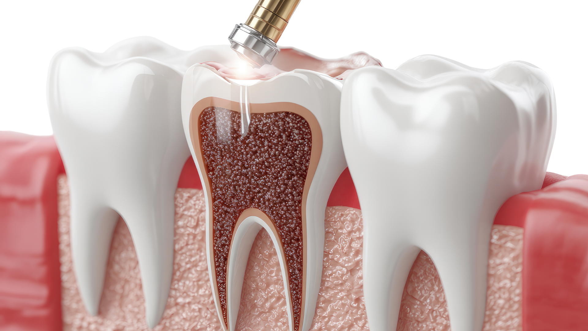 Cross-section tooth model; root canal being performed.