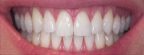 Close-up of bright white teeth in a smiling mouth with healthy pink gums.
