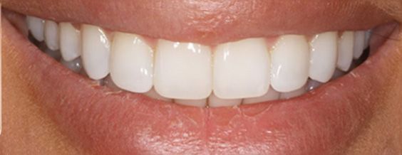 Close-up of a smiling person's white teeth and pink lips.