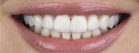 A close-up of a person's smiling mouth, showing white, evenly spaced teeth and pink lips.