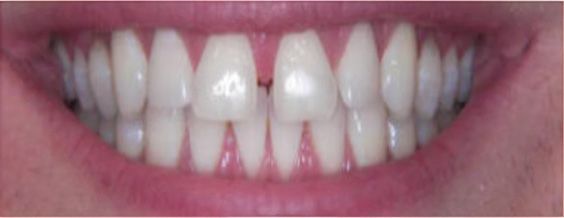 Close-up of teeth, showing white teeth with a gap between the two front teeth. The person is smiling.
