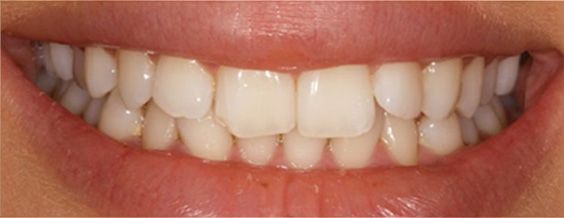 Close-up of a person's teeth, showing a slightly crooked smile, with visible white teeth and pink gums.
