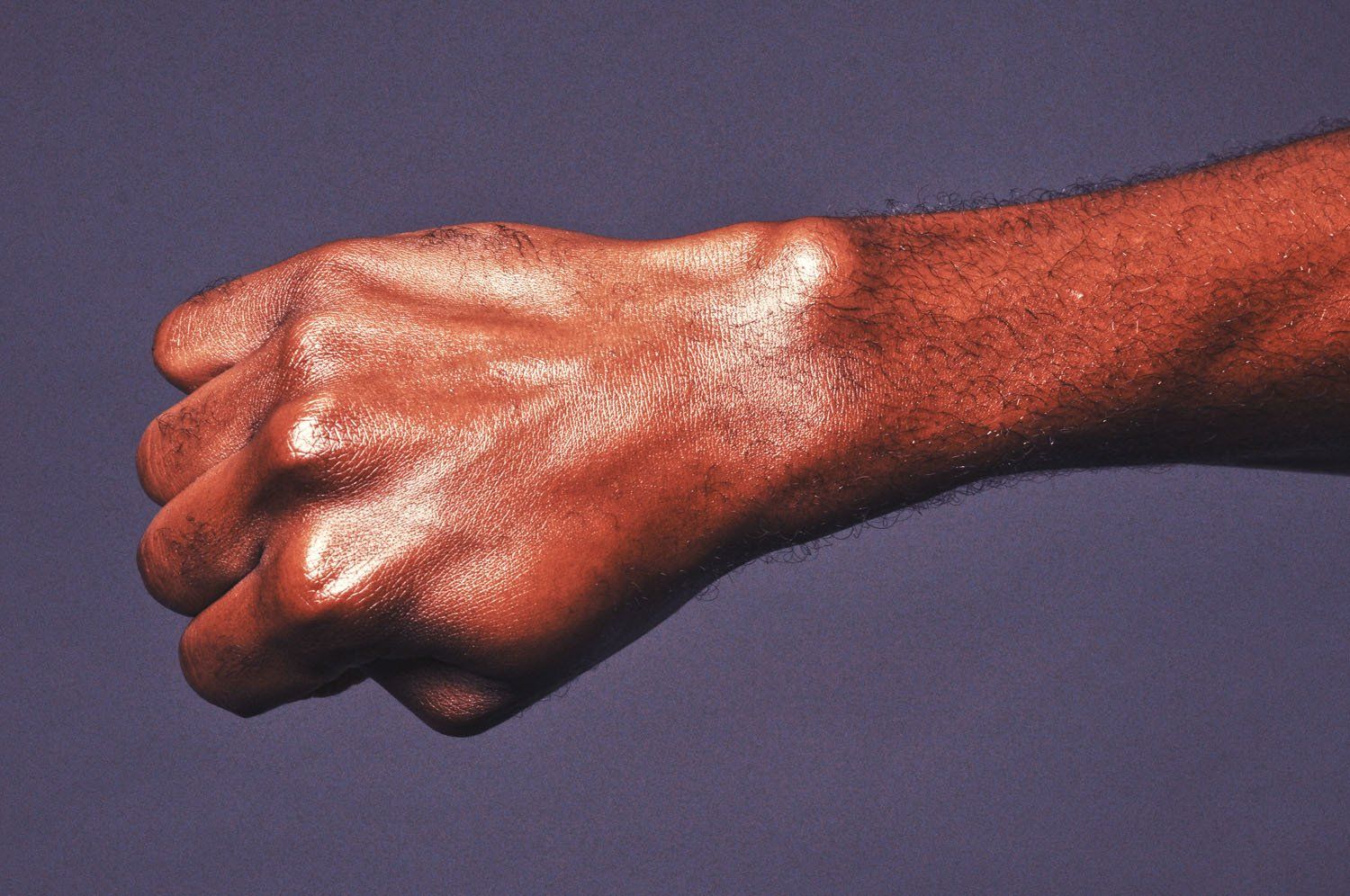 A close up of a person 's hand with a large lump on it.