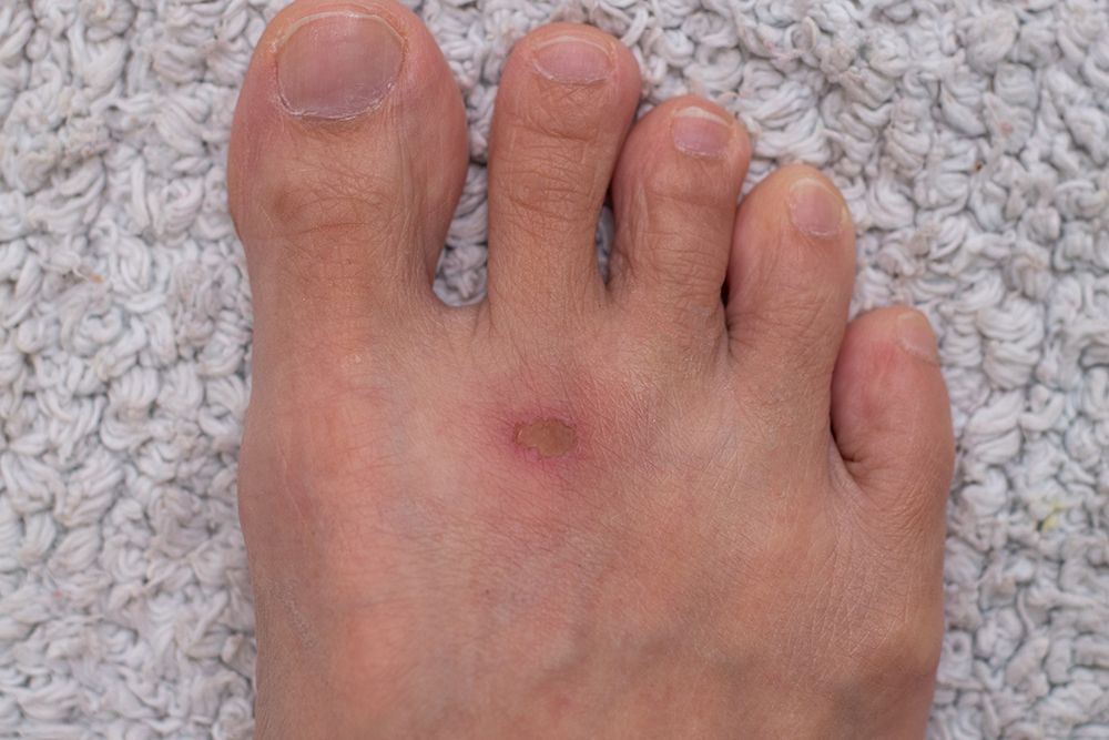 Diabetic Foot Ulcer