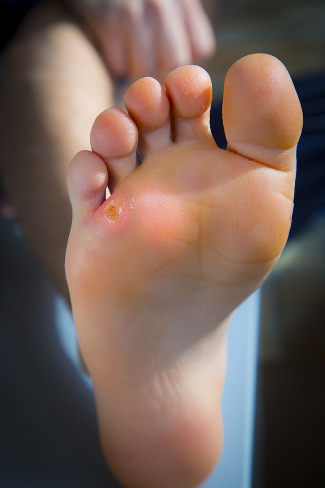 Corns & Calluses