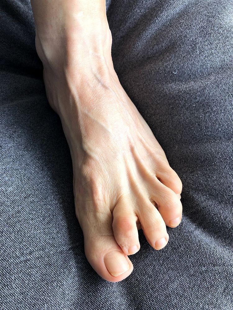 Hammertoes