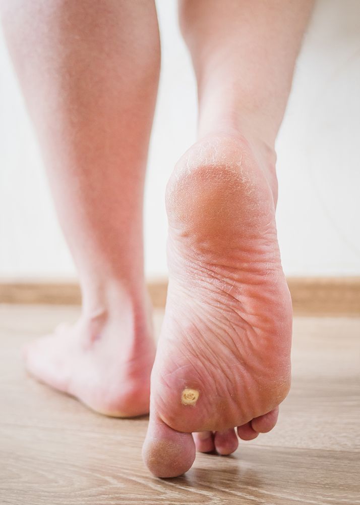 Plantar Warts