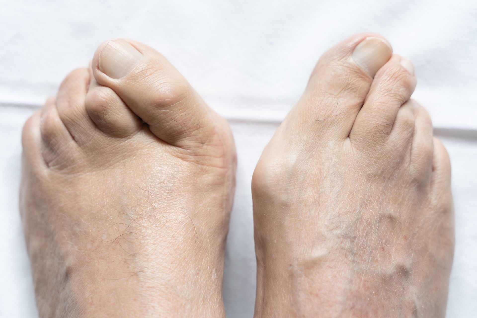 Hammertoes