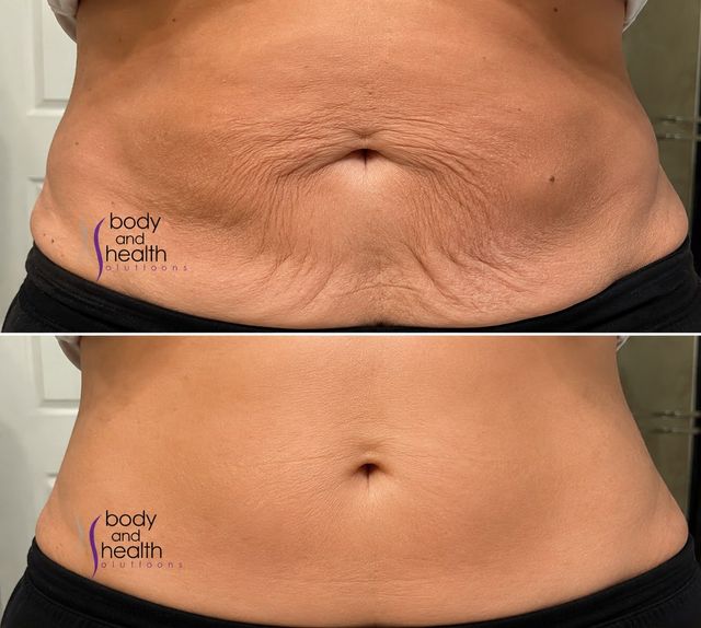 Side profile before and after abdomen tightening after 20 weeks