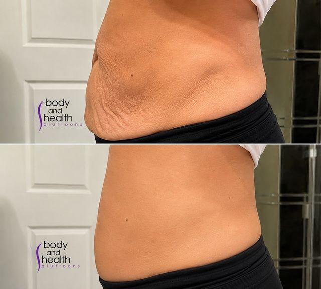 Stacked before and after abdomen skin tightening comparison