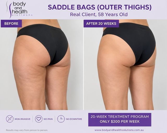 Before and after saddle bags outer thigh treatment after 20 weeks