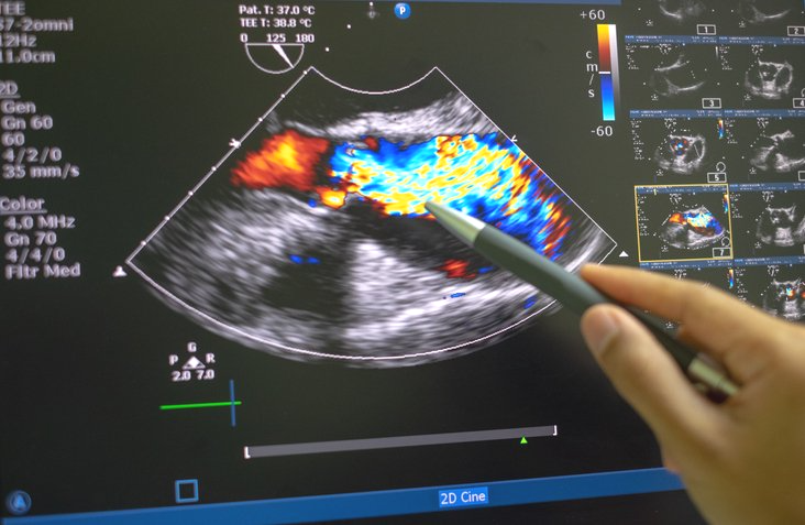Image of Echocardiography Result
