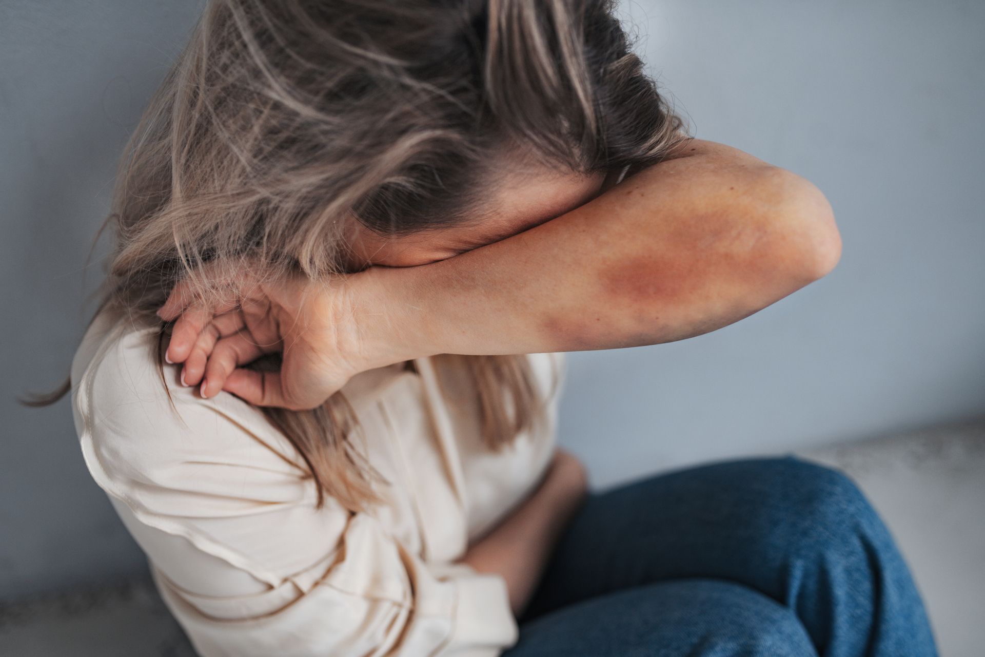 A woman with a bruise on her elbow is covering her face with her hand.