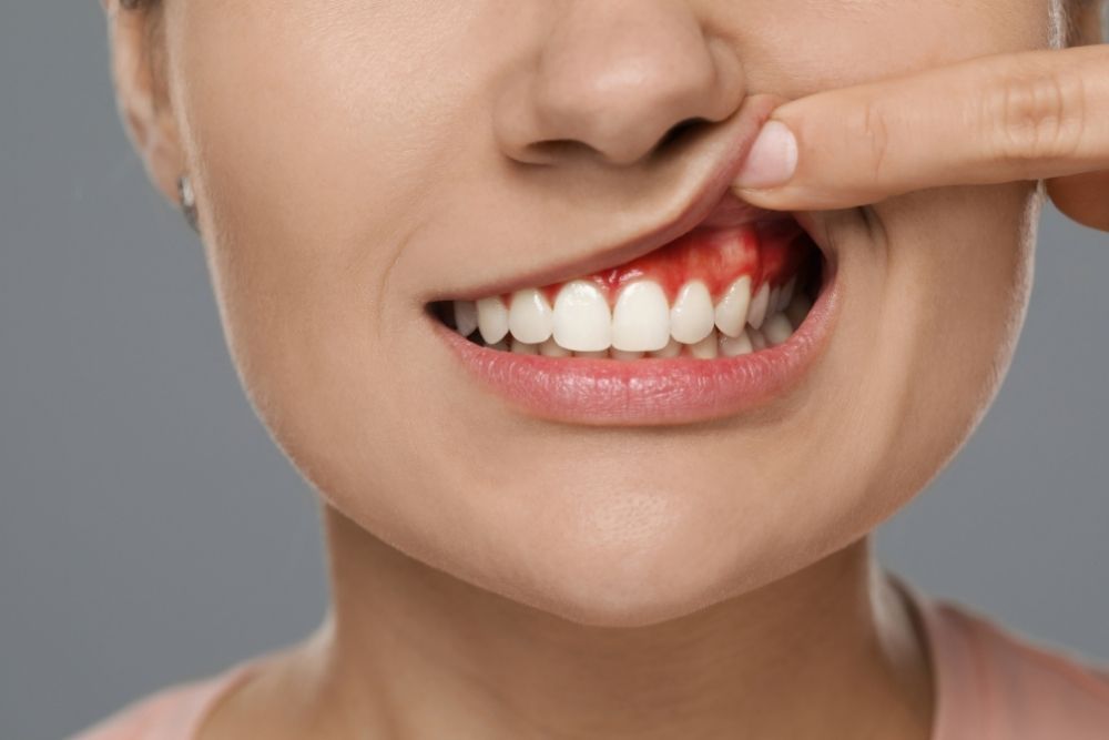 Woman's mouth, finger pulling lip exposing inflamed, bleeding gums around white teeth.