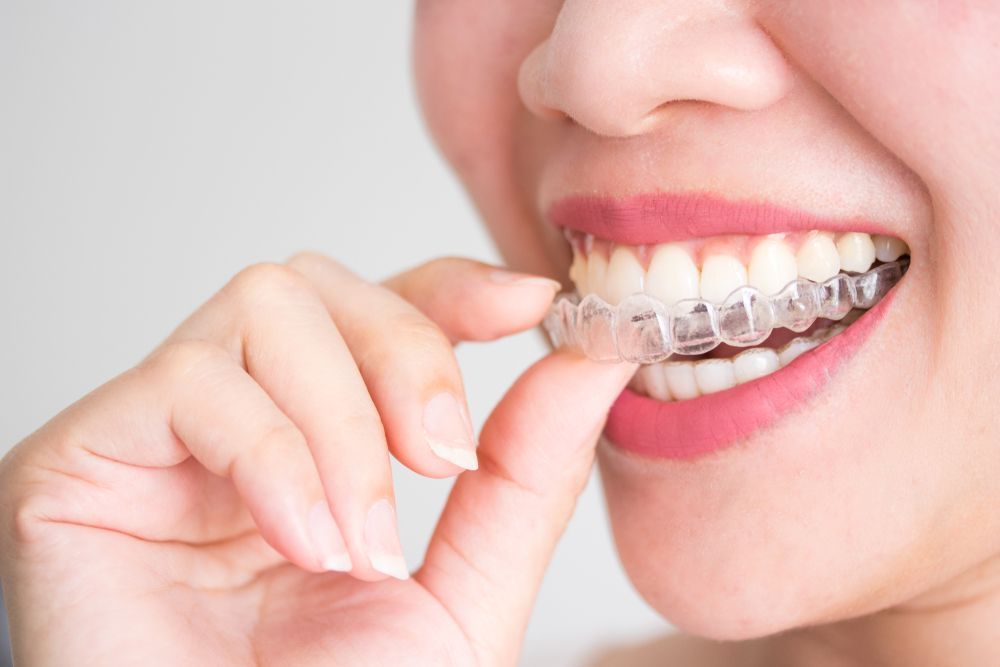 Woman putting in clear aligners; close-up of mouth and hands, neutral background.
