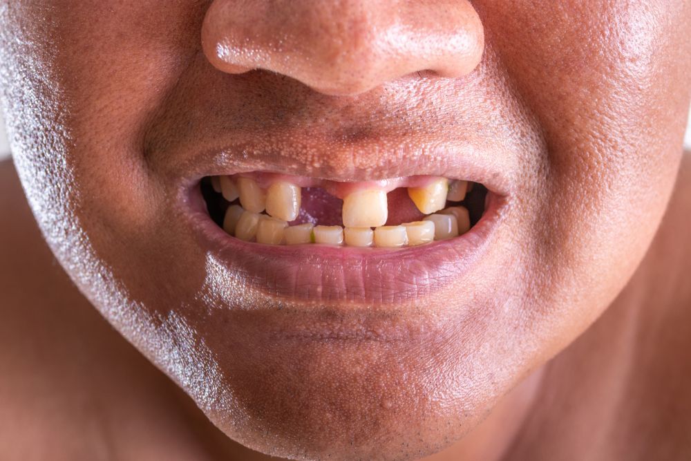 Close-up of a person's mouth with a missing tooth and discolored teeth, showing an unhappy expression.