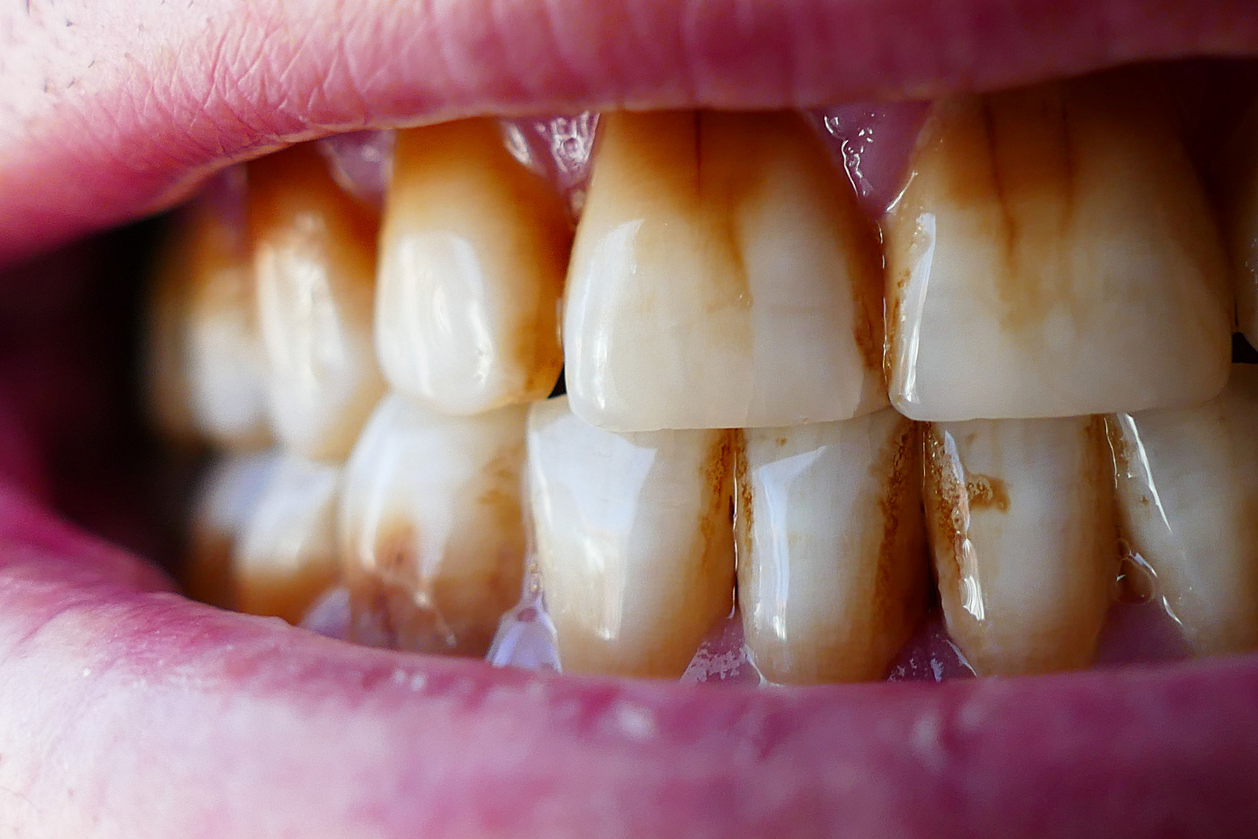 Close-up of teeth with significant brown staining at the gum line.