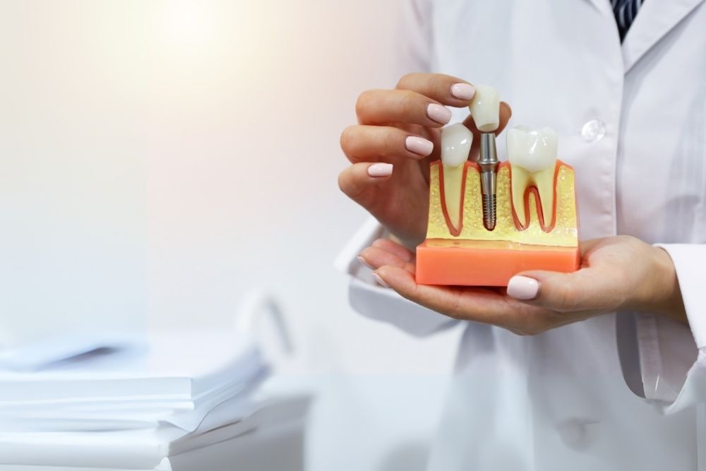 Dentist holding a model of a tooth implant, showing the root and crown.