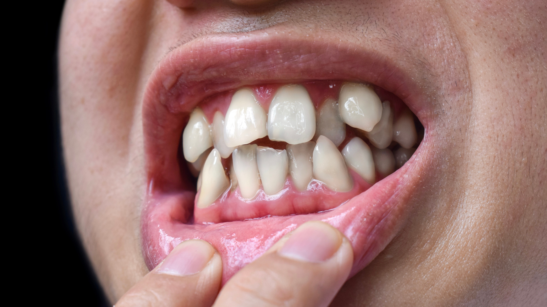 Mouth open, showing teeth; some crooked and chipped. Finger pulling down lower lip.