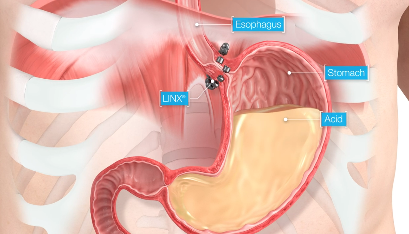 A diagram of the stomach and esophagus of a person.