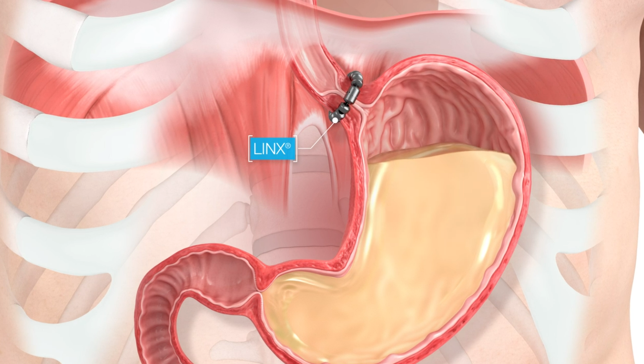 A close up of a person 's stomach with a needle in it.