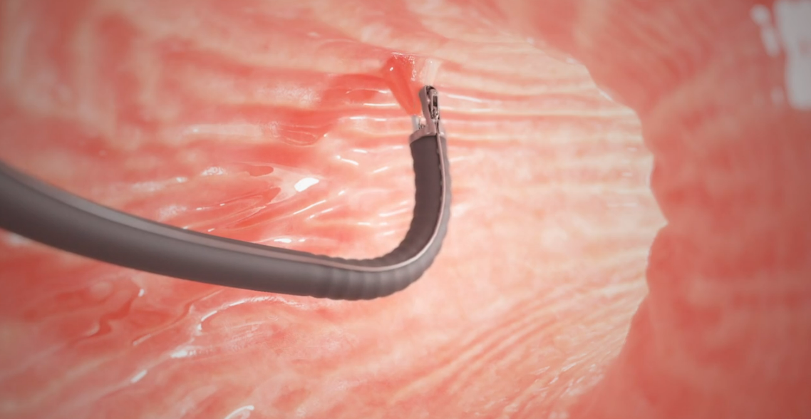 A close up of a needle in a person 's stomach.