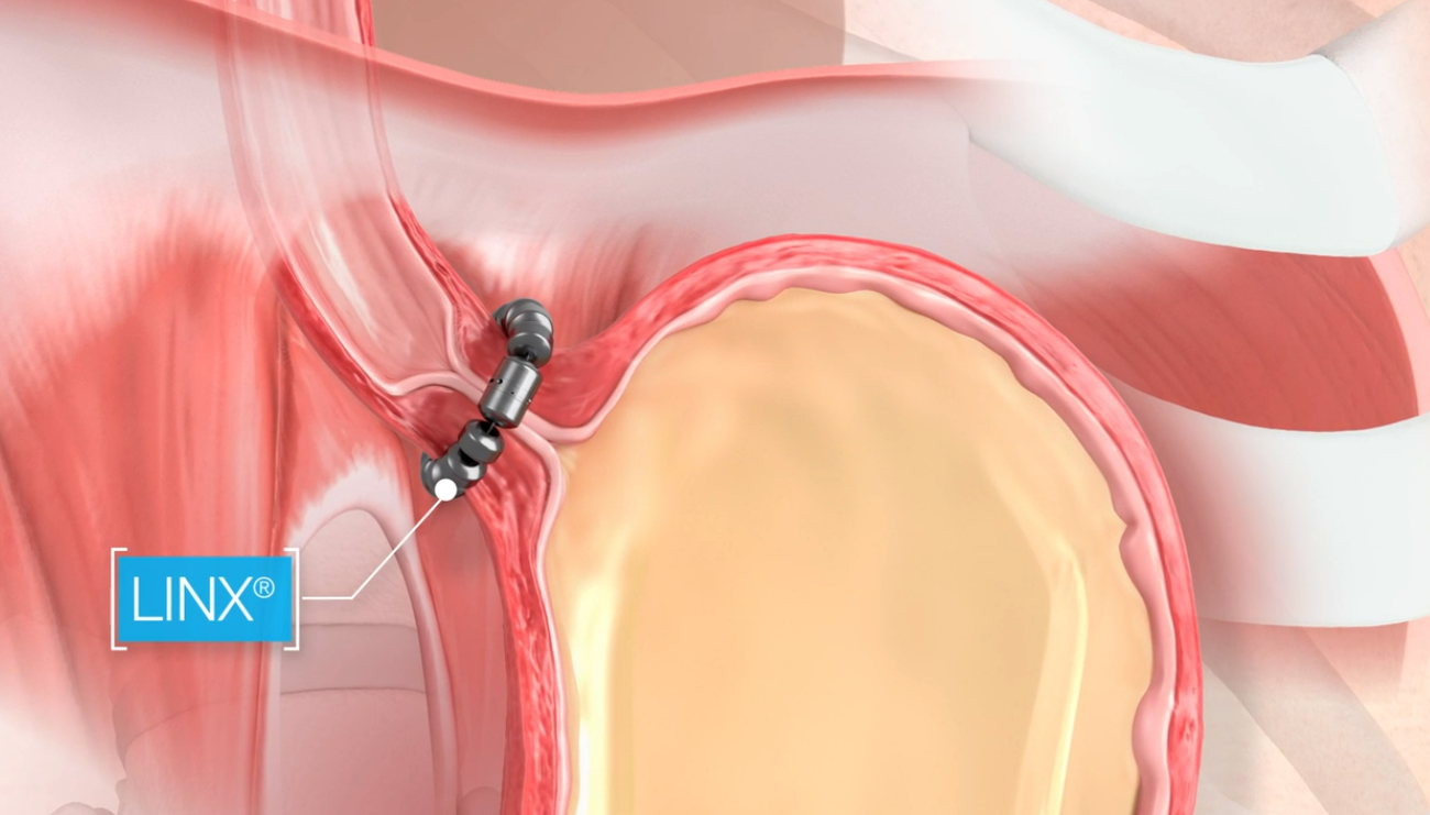 A close up of a person 's shoulder with a device attached to it.