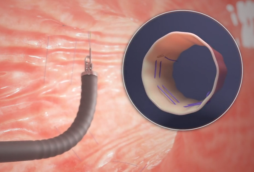 A needle is being inserted into a hole in the stomach