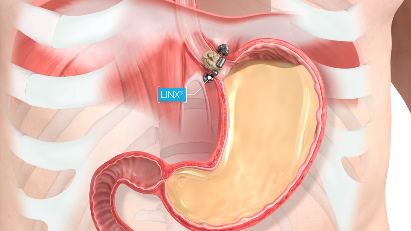 A drawing of a person 's stomach with a device in it.