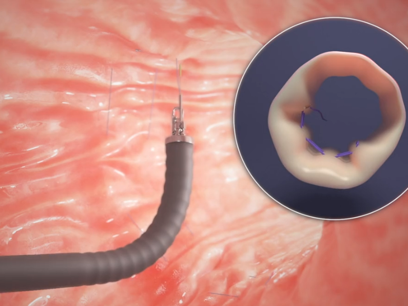 A needle is being used to remove a tooth from a person 's mouth