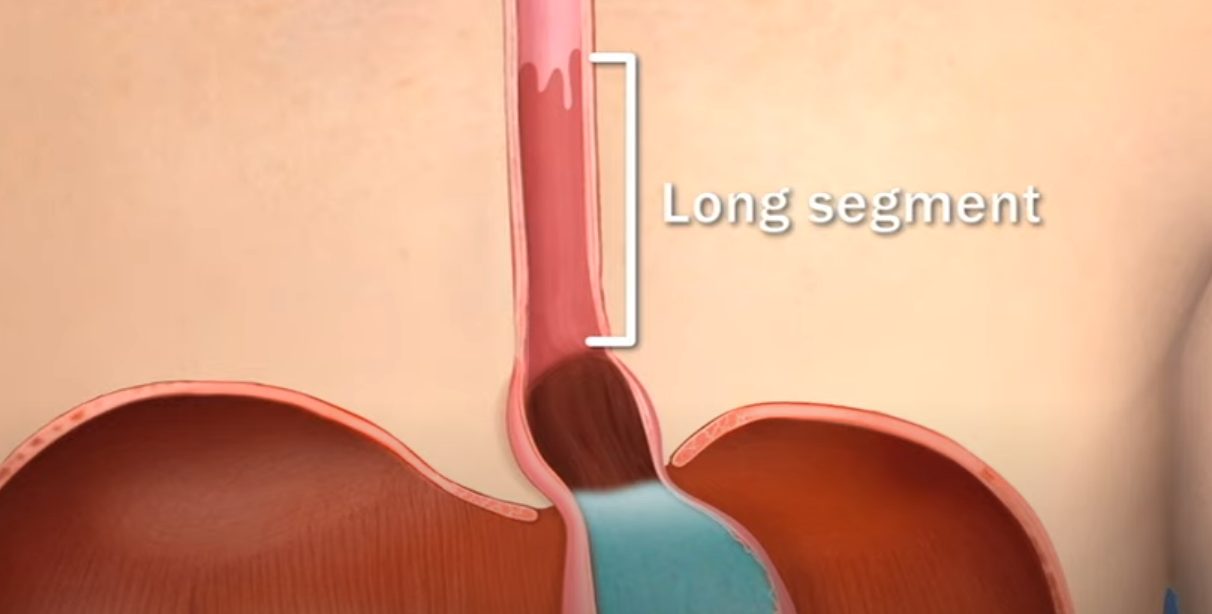 A computer generated image of a person 's esophagus showing the long segment.