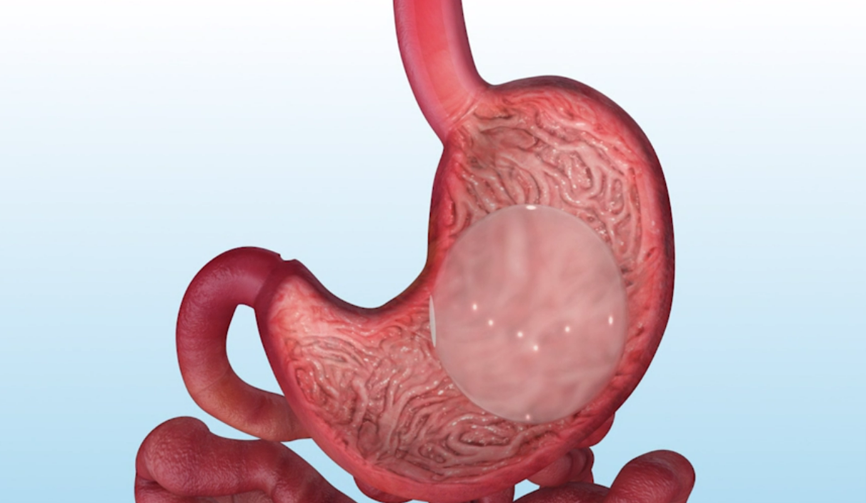 A model of a human stomach with a balloon in it.