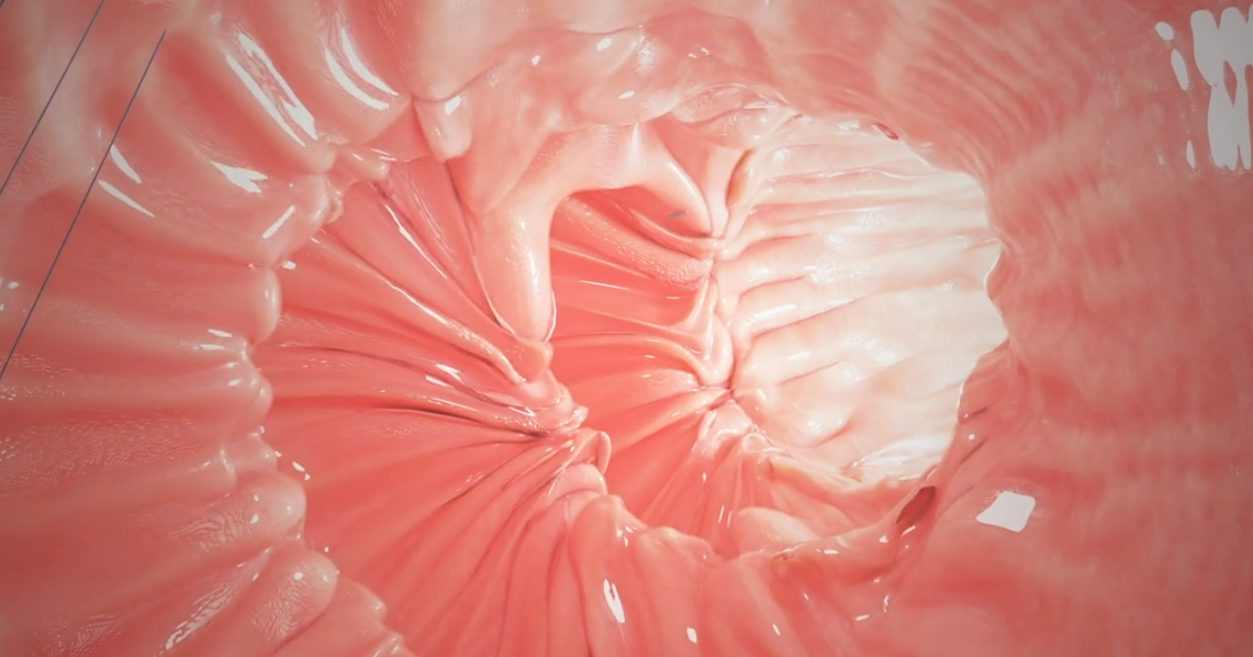 A close up of a stomach with a hole in it.