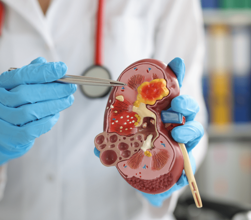 Médico de jaleco branco e luvas segurando um modelo de rim, apontando com uma pinça para uma seção com uma massa amarela e manchas vermelhas.