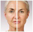 Before And After Comparison Model 1 — Clinton, TN — Premier Weight Management & Aestheics, LLC