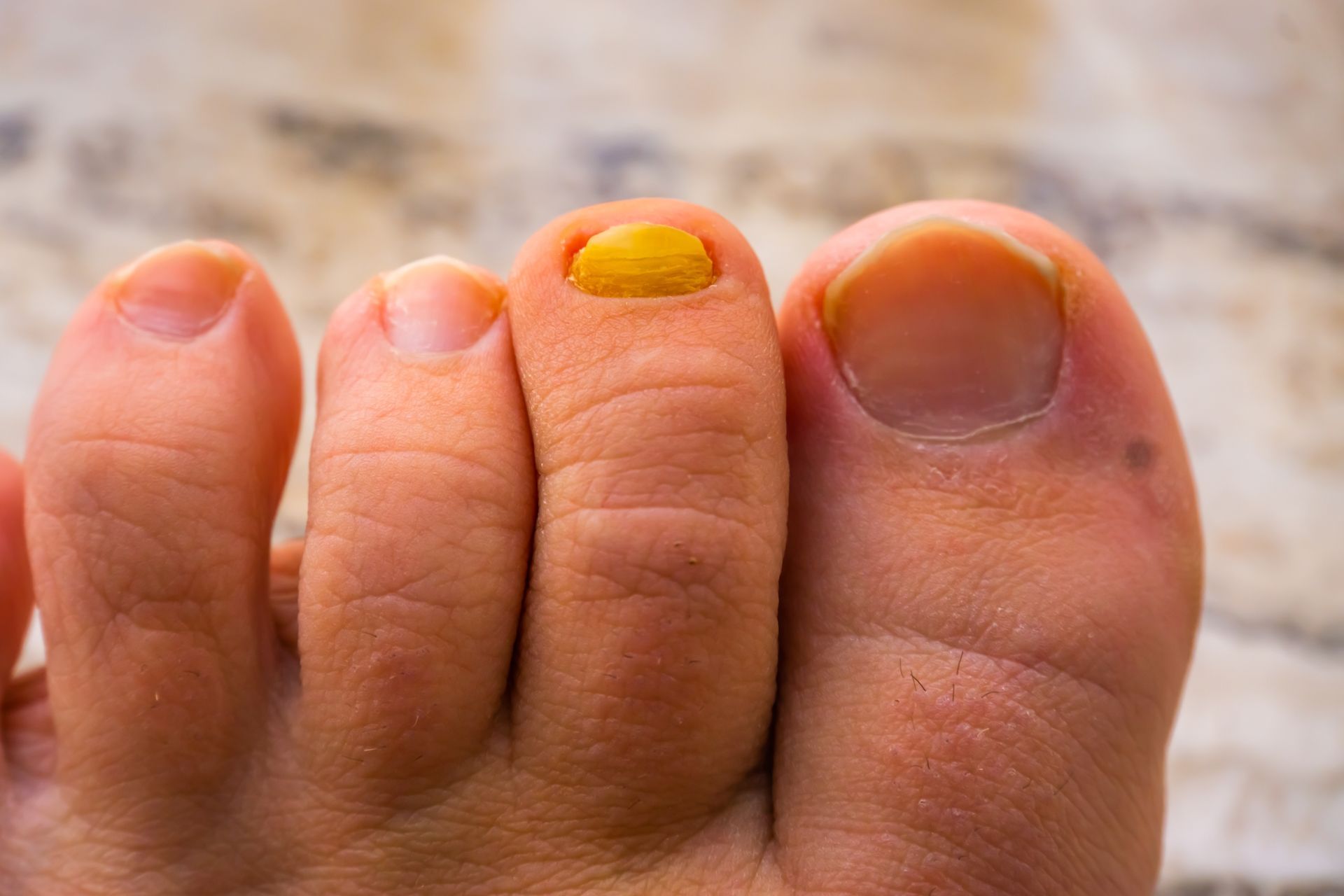 Close-up of a foot with several toes; one toenail is thick, yellowed, and discolored.