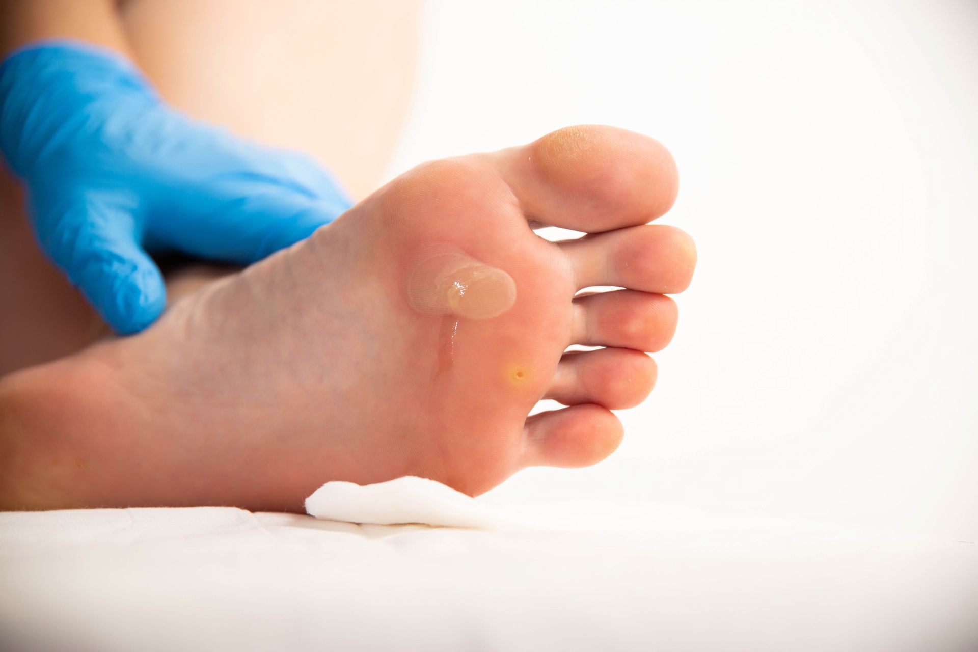 Foot with blisters on the sole; a gloved hand examines the foot with a cotton swab nearby.