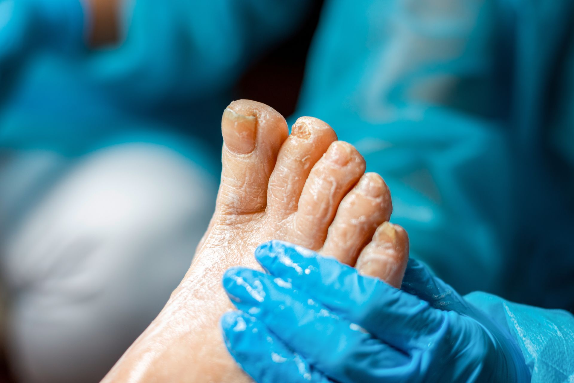 Foot with dry skin being treated by a person wearing blue gloves.