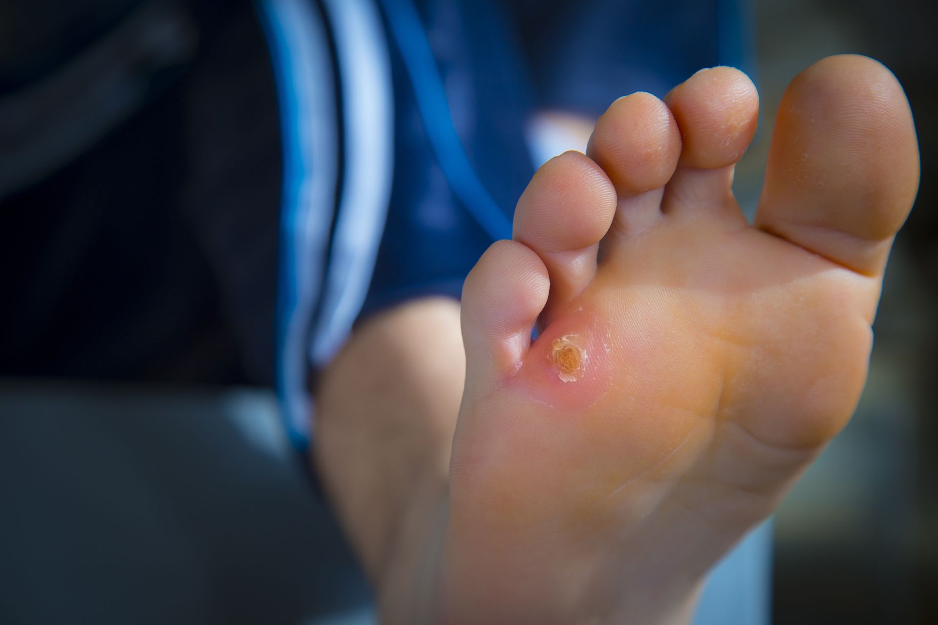 Sole of a foot with a plantar wart; light skin, center of foot, with raised, yellowish growth.
