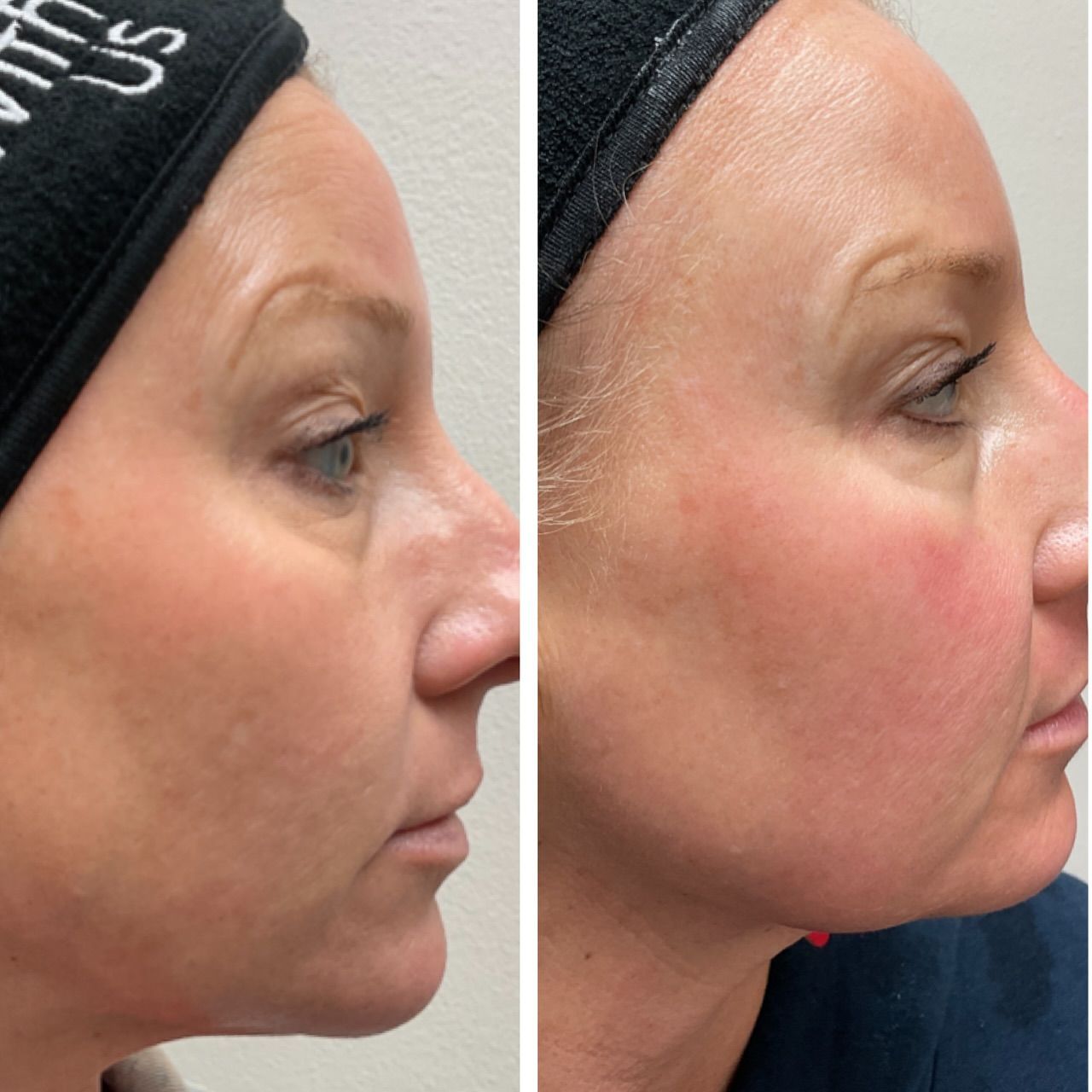 A before and after picture of a woman 's face