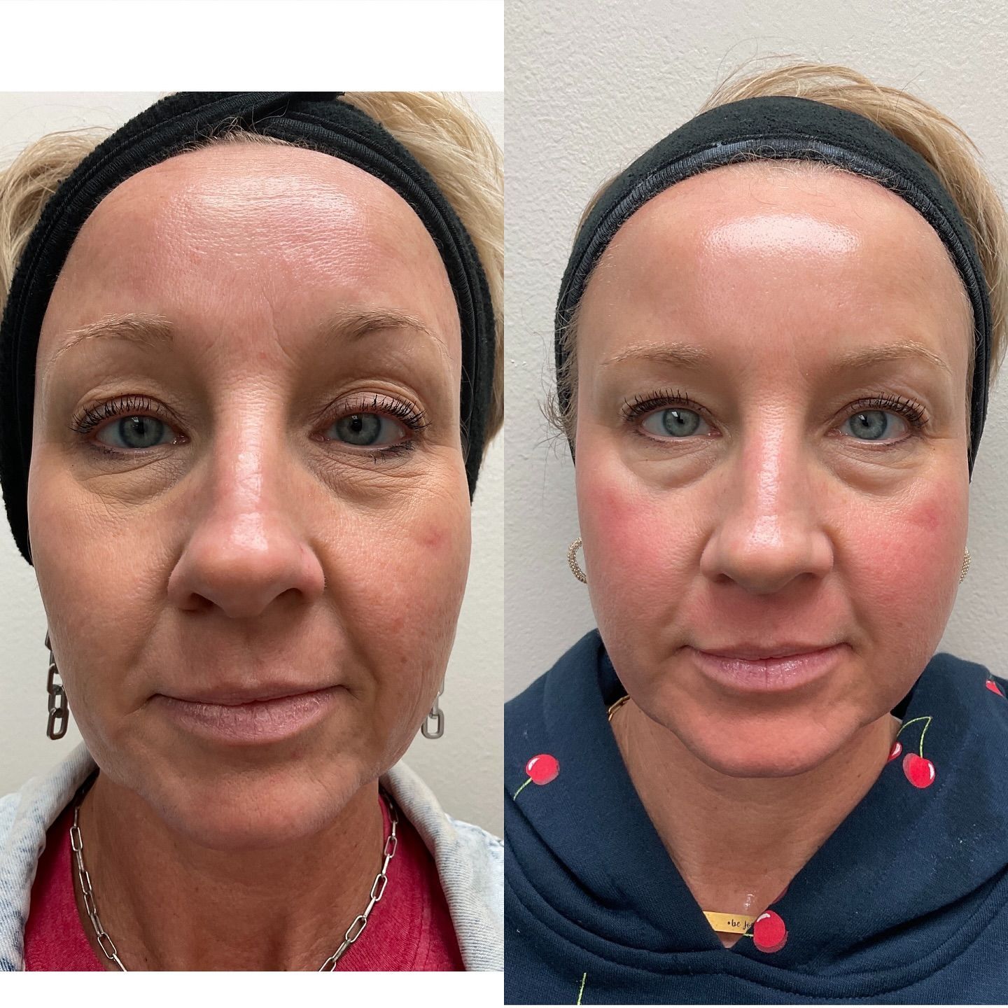 A before and after photo of a woman 's face. 