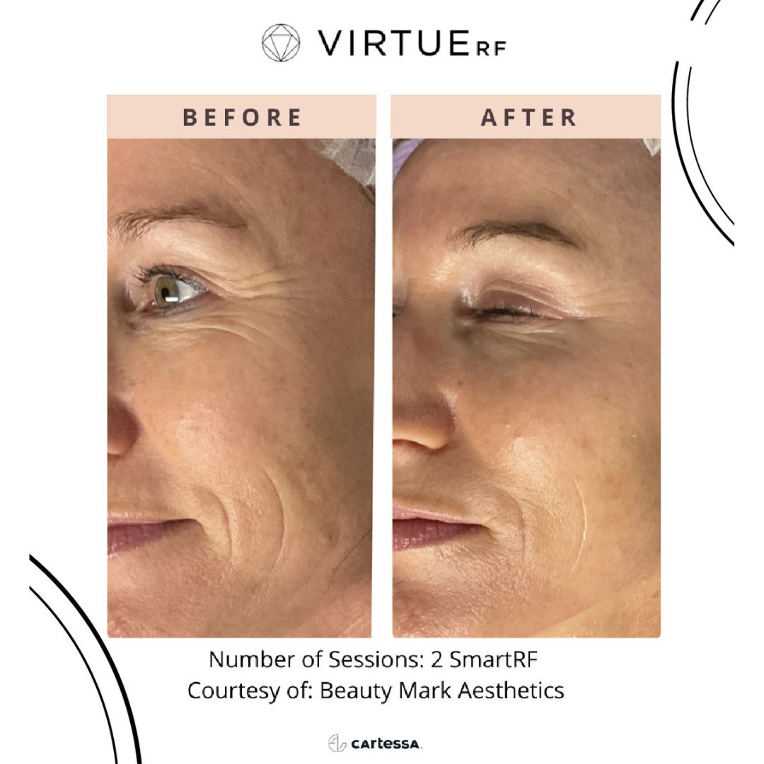 A before and after photo of a woman 's face. 