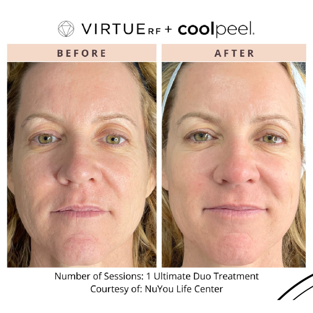 A before and after photo of a woman 's face. 