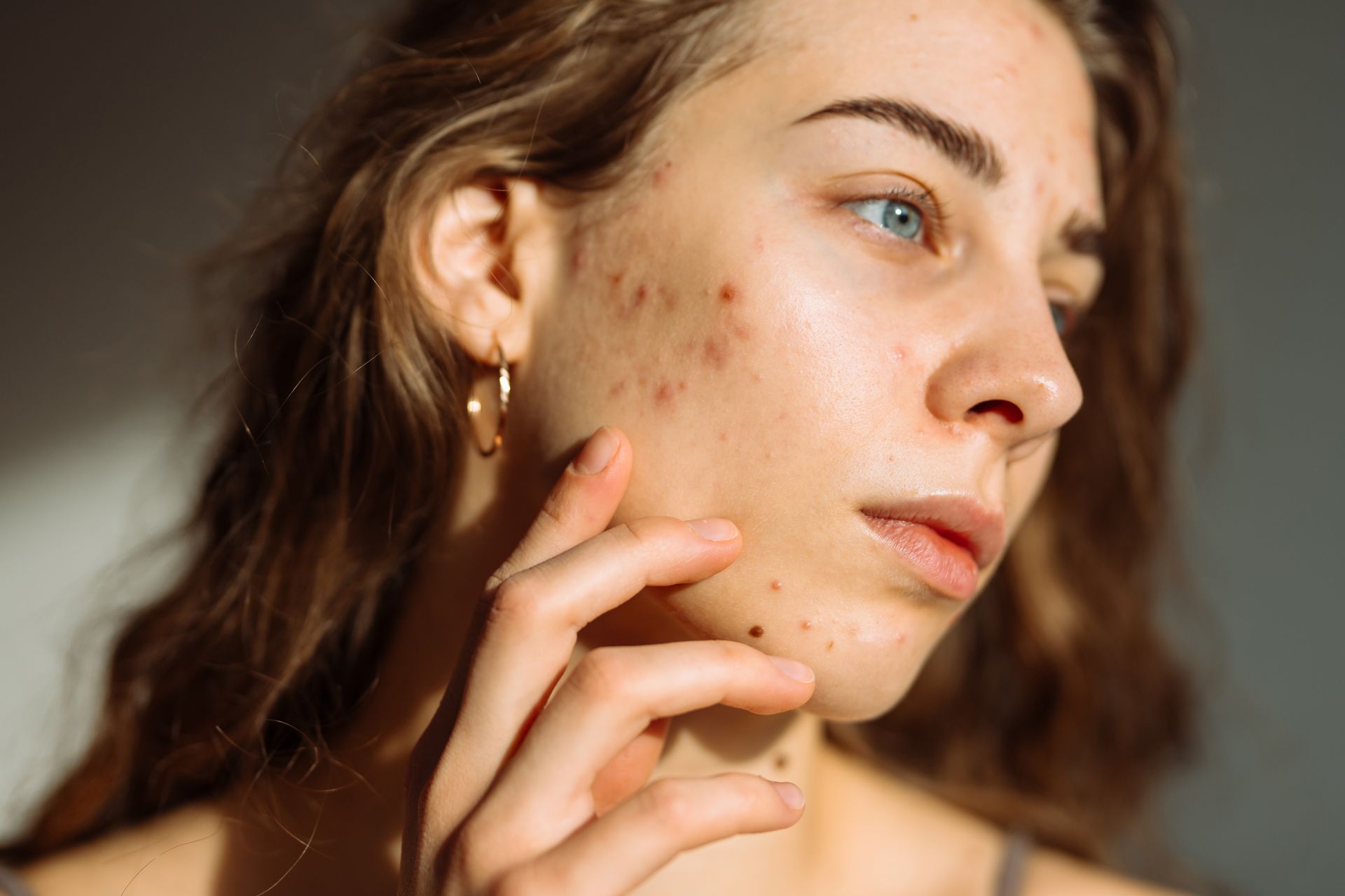 Woman with acne touching her face, natural light.