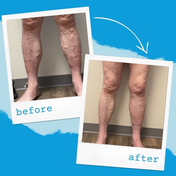 varicose vein before and after photo of legs