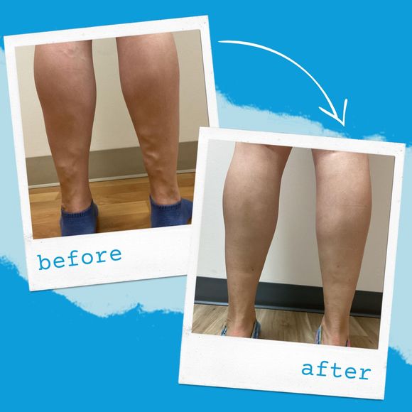 varicose vein before and after photo of legs