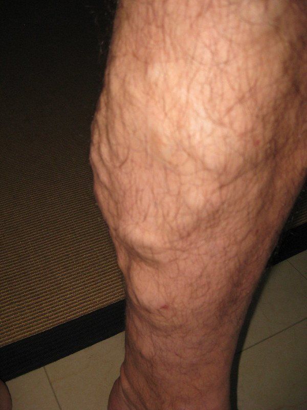 Varicose veins on man's leg