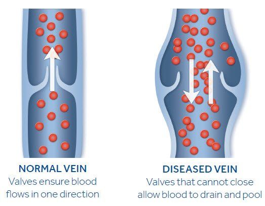 Vein Disease Illustration varicose veins