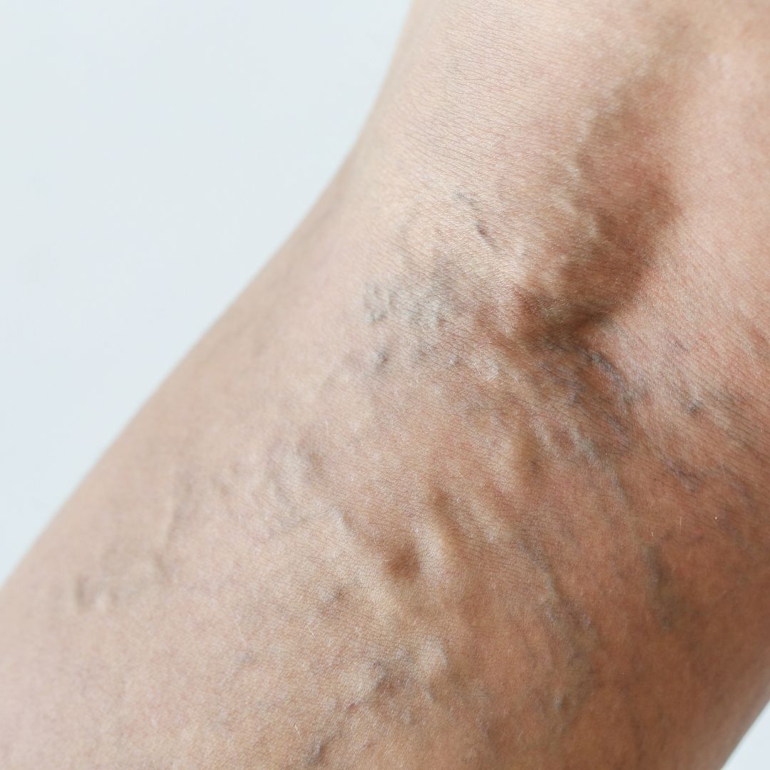 Varicose veins on the back of the leg